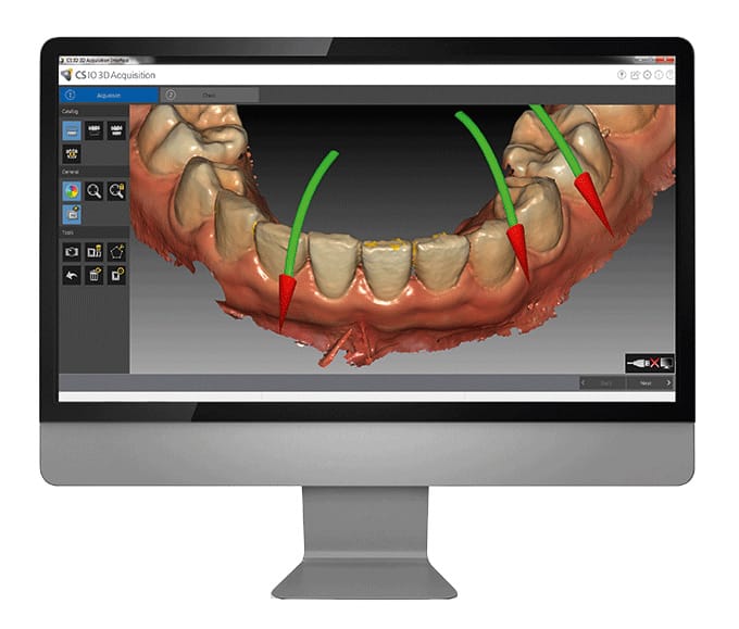 Digitale Abformung Screen Darstellung einer digitale Abformung am Computerbildschirm