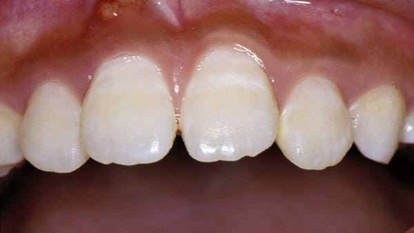 Diese Abbildung zeigt eine leichte Fluorose